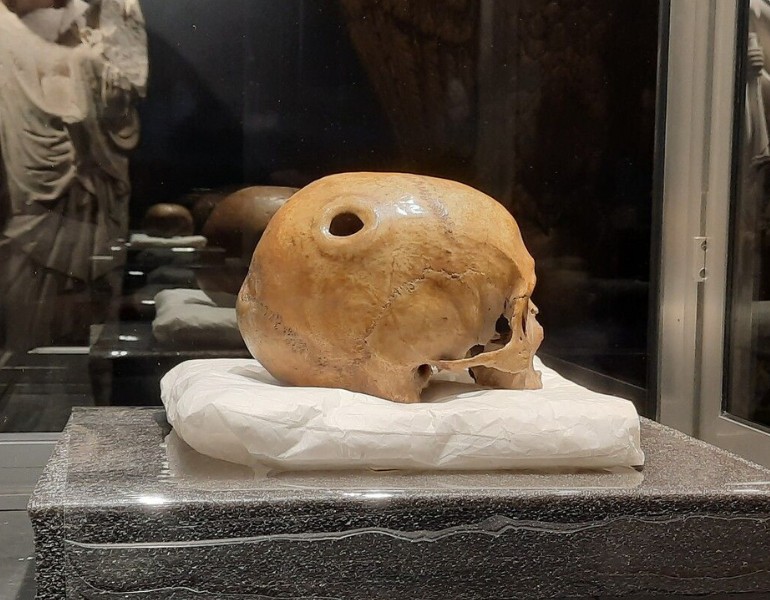 Le crâne percé de Saint-Aubert