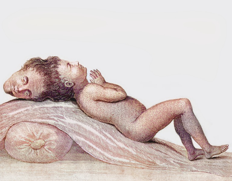 Croquis d'époque représentant l'enfant à deux têtes